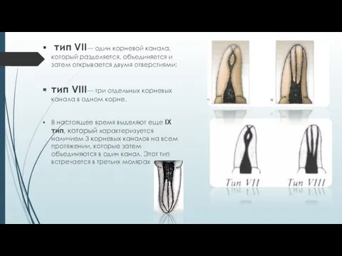 тип VII— один корневой канала, который разделяется, объединяется и за­тем