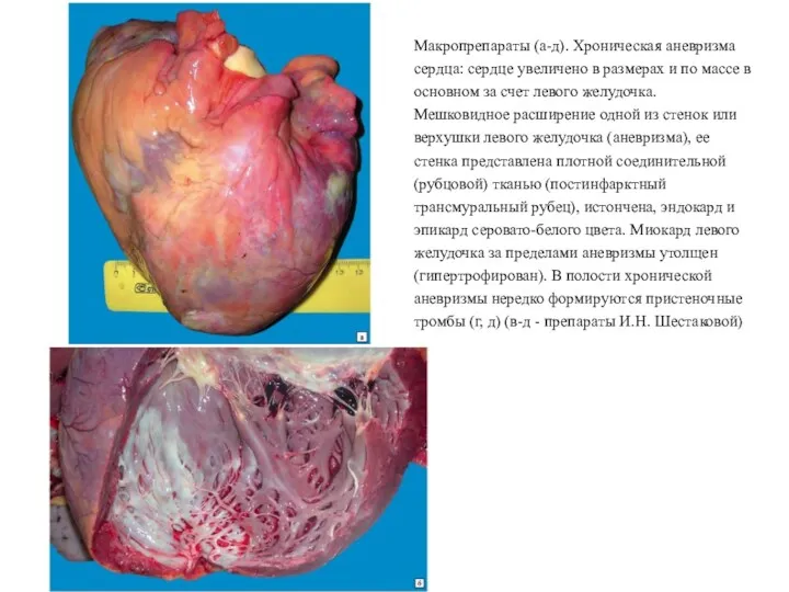 Макропрепараты (а-д). Хроническая аневризма сердца: сердце увеличено в размерах и