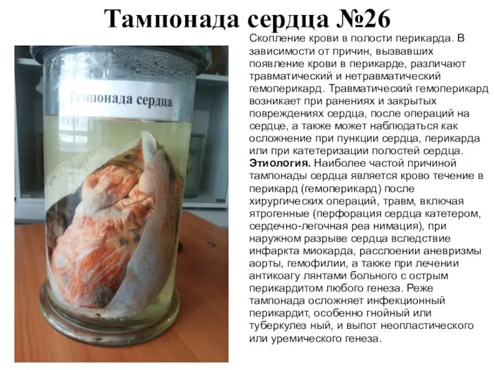 Тампонада сердца №26 Скопление крови в полости перикарда. В зависимости от причин, вызвавших