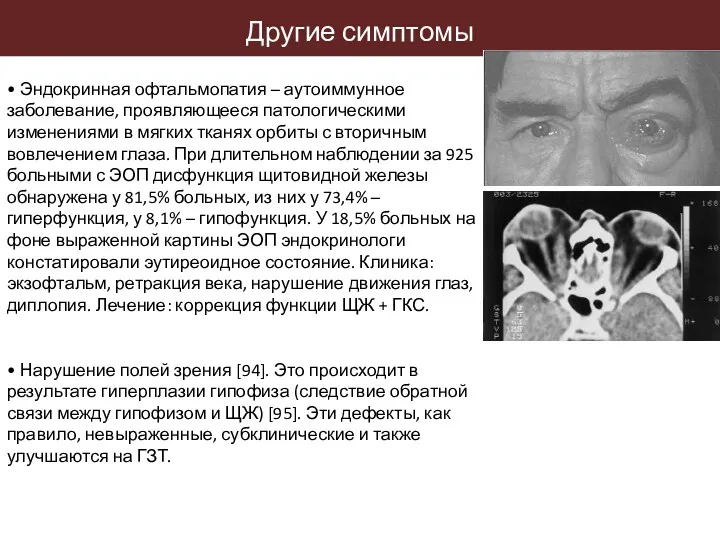 • Эндокринная офтальмопатия – аутоиммунное заболевание, проявляющееся патологическими изменениями в