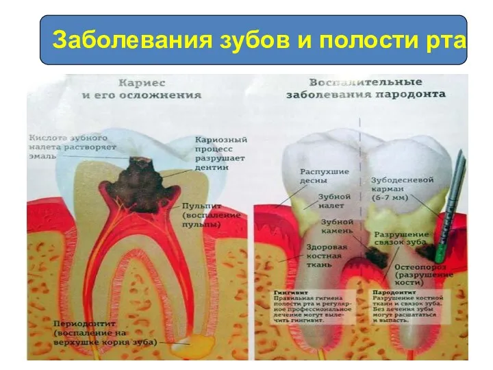 Заболевания зубов и полости рта