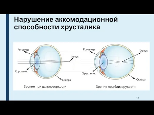 Нарушение аккомодационной способности хрусталика