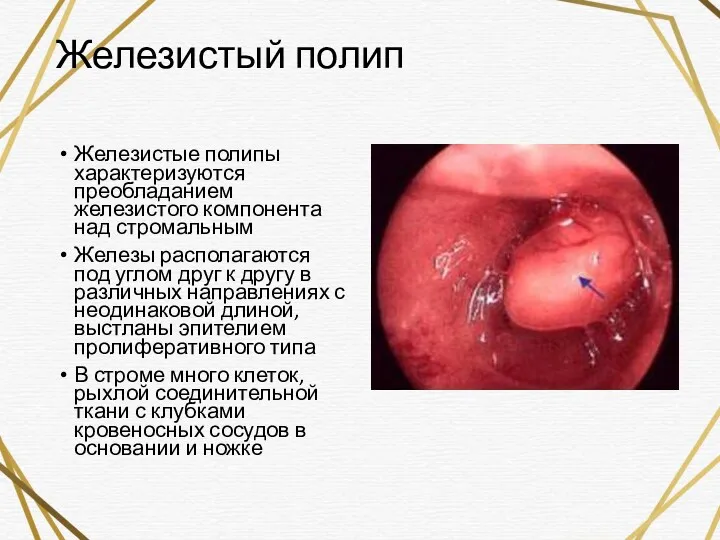 Железистый полип Железистые полипы характеризуются преобладанием железистого компонента над стромальным