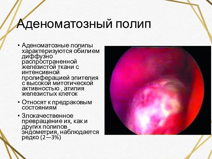 Аденоматозный полип Аденоматозные полипы характеризуются обилием диффузно распространенной железистой ткани