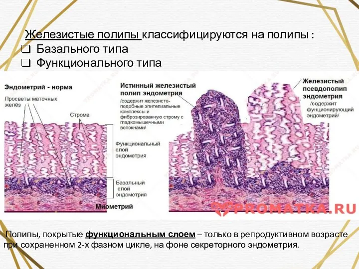 Железистые полипы классифицируются на полипы : Базального типа Функционального типа