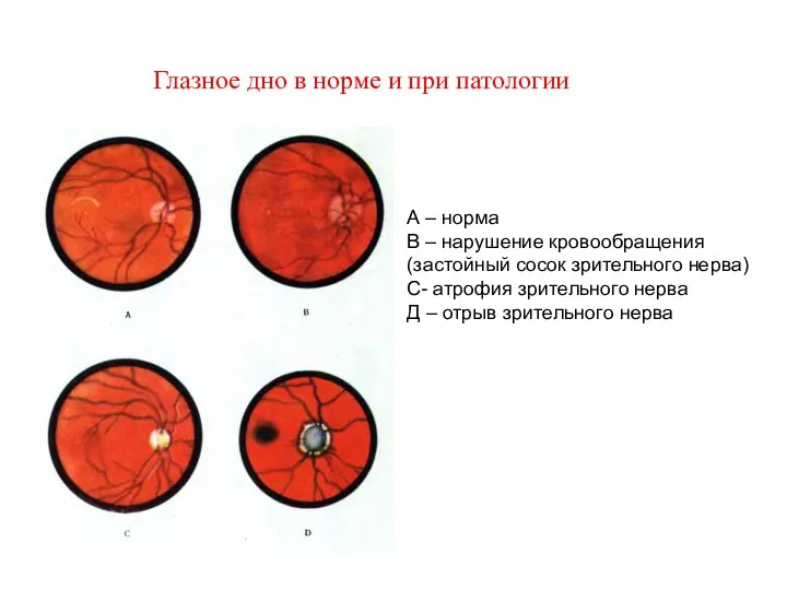 А – норма В – нарушение кровообращения (застойный сосок зрительного нерва) С- атрофия