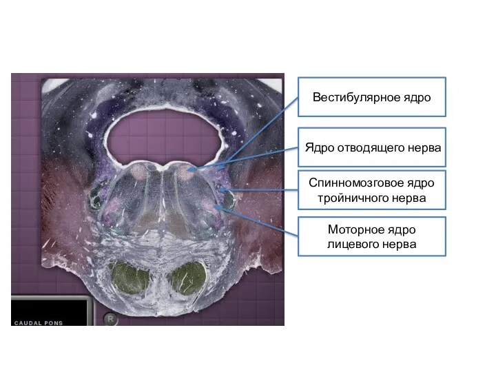 Вестибулярное ядро Ядро отводящего нерва Спинномозговое ядро тройничного нерва Моторное ядро лицевого нерва