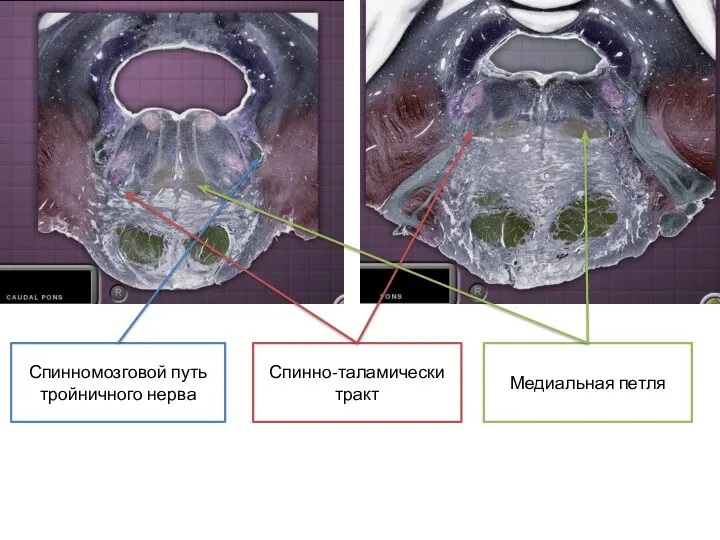 Спинномозговой путь тройничного нерва Медиальная петля Спинно-таламически тракт