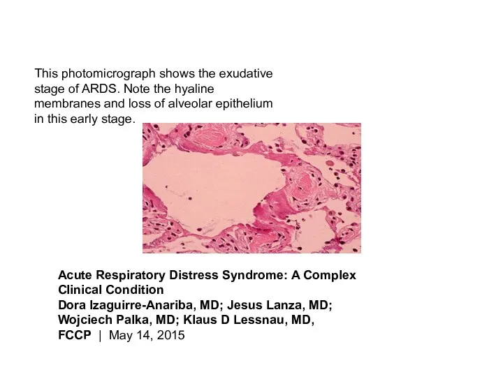 This photomicrograph shows the exudative stage of ARDS. Note the hyaline membranes and