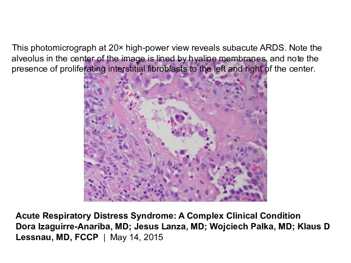 This photomicrograph at 20× high-power view reveals subacute ARDS. Note the alveolus in