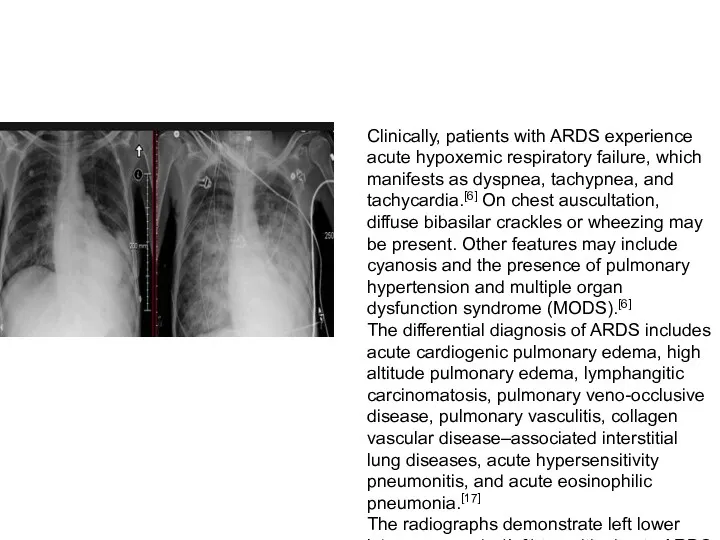 Clinically, patients with ARDS experience acute hypoxemic respiratory failure, which manifests as dyspnea,