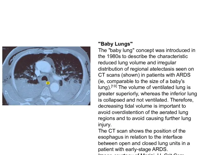 "Baby Lungs" The "baby lung" concept was introduced in the 1980s to describe