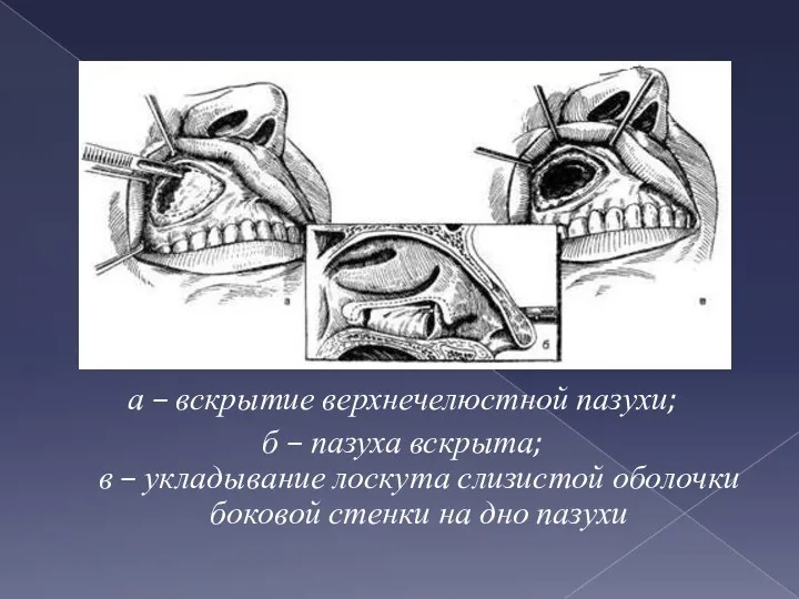 а – вскрытие верхнечелюстной пазухи; б – пазуха вскрыта; в