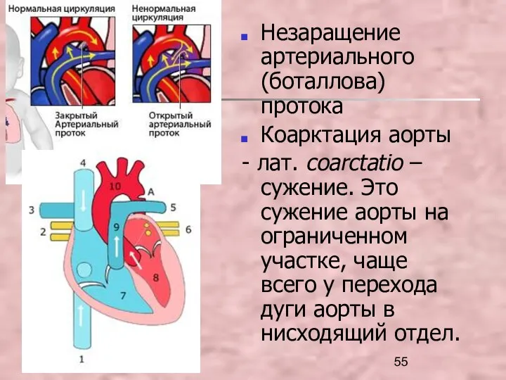 Незаращение артериального (боталлова) протока Коарктация аорты - лат. coarctatio –