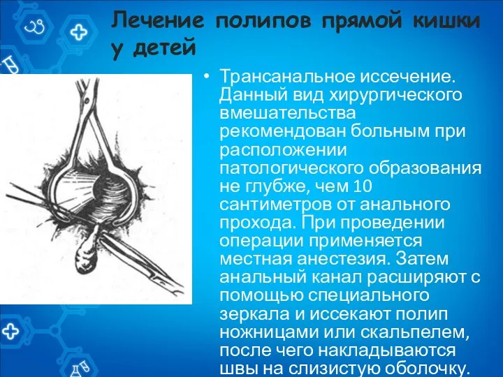 Лечение полипов прямой кишки у детей Трансанальное иссечение. Данный вид