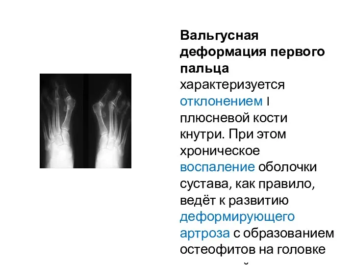 Вальгусная деформация первого пальца характеризуется отклонением I плюсневой кости кнутри.