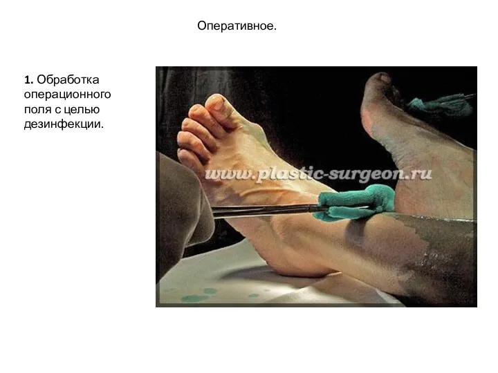 Оперативное. 1. Обработка операционного поля с целью дезинфекции.