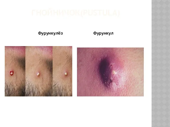 ГНОЙНИЧОК(PUSTULA) Фурункулёз Фурункул