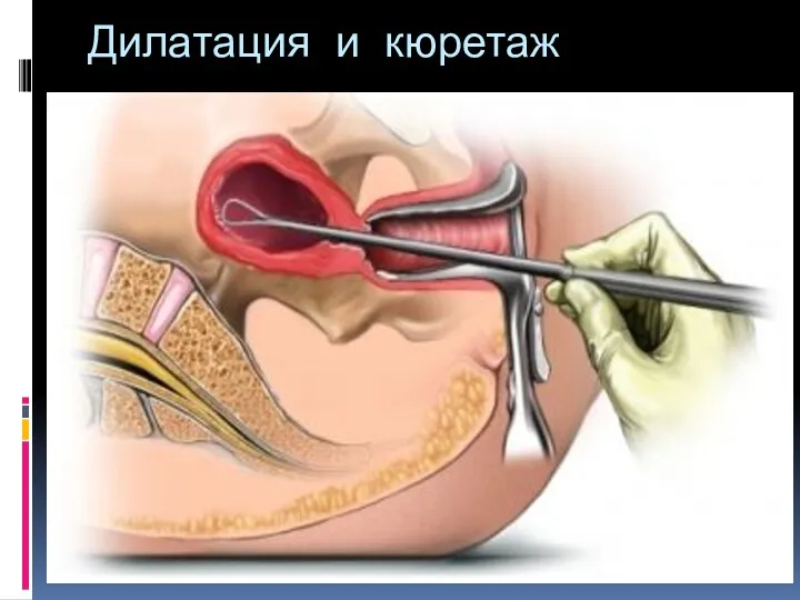 Дилатация и кюретаж