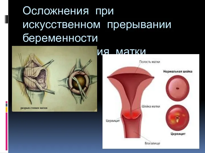 Осложнения при искусственном прерывании беременности 1. заболевания матки