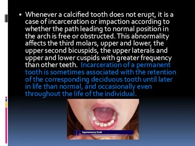 Whenever a calcified tooth does not erupt, it is a
