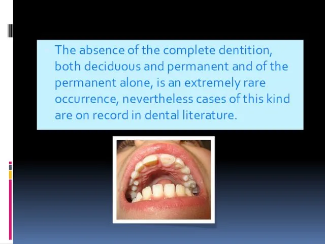 The absence of the complete dentition, both deciduous and permanent