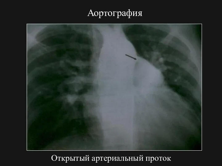 Аортография Открытый артериальный проток