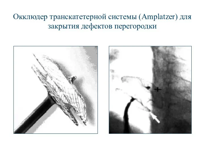 Окклюдер транскатетерной системы (Amplatzer) для закрытия дефектов перегородки