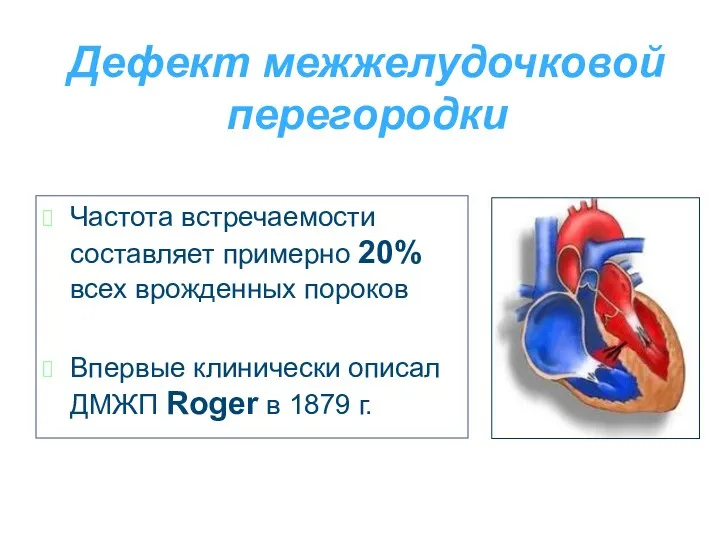 Дефект межжелудочковой перегородки Частота встречаемости составляет примерно 20% всех врожденных