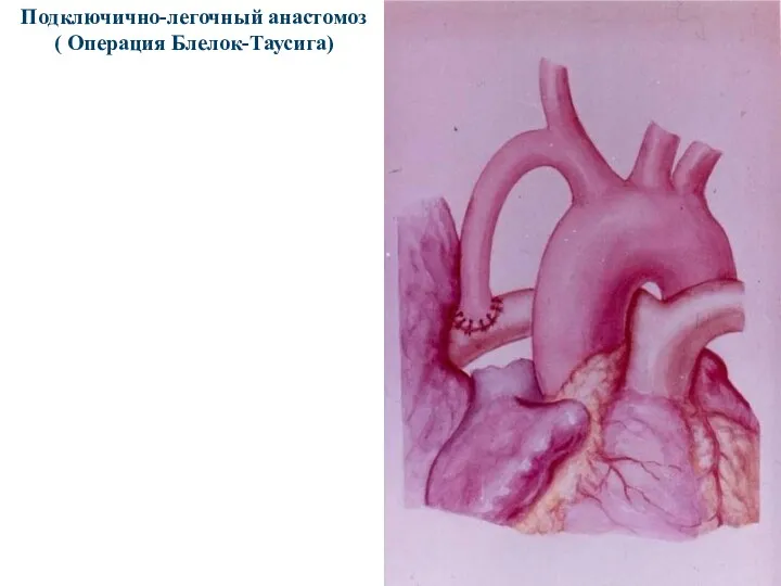 Подключично-легочный анастомоз ( Операция Блелок-Таусига)