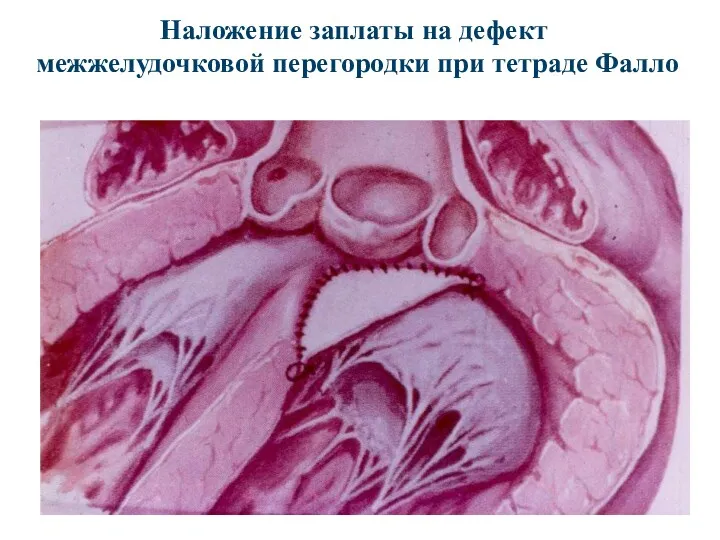 Наложение заплаты на дефект межжелудочковой перегородки при тетраде Фалло