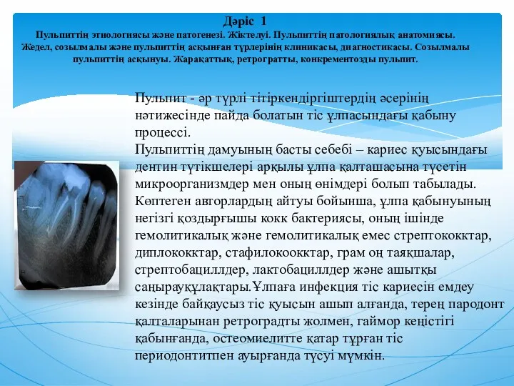 Дәріс 1 Пульпиттің этиологиясы және патогенезі. Жіктелуі. Пульпиттің патологиялық анатомиясы.