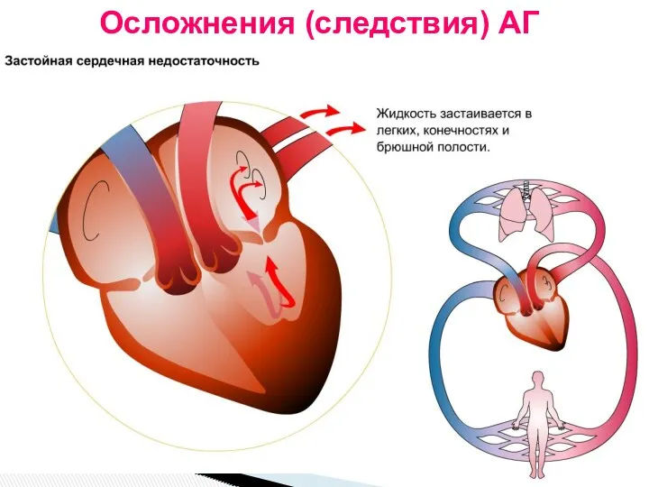 Осложнения (следствия) АГ