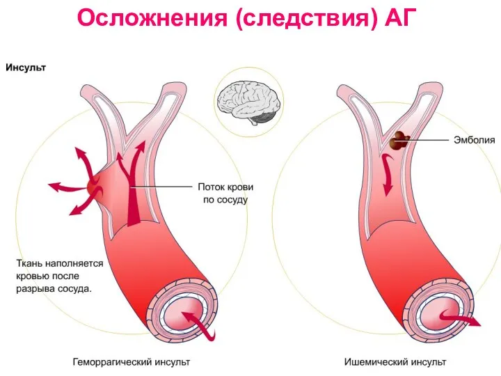 Осложнения (следствия) АГ