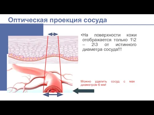 Оптическая проекция сосуда Можно удалить сосуд с мах диаметром 6