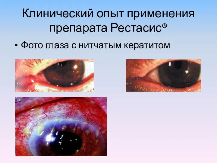 Клинический опыт применения препарата Рестасис® Фото глаза с нитчатым кератитом