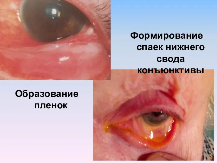 Образование пленок Формирование спаек нижнего свода конъюнктивы