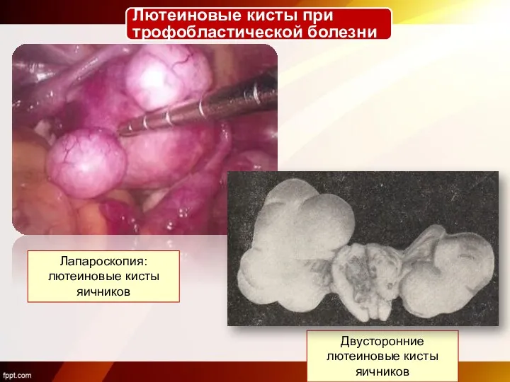 Двусторонние лютеиновые кисты яичников Лапароскопия: лютеиновые кисты яичников Лютеиновые кисты при трофобластической болезни