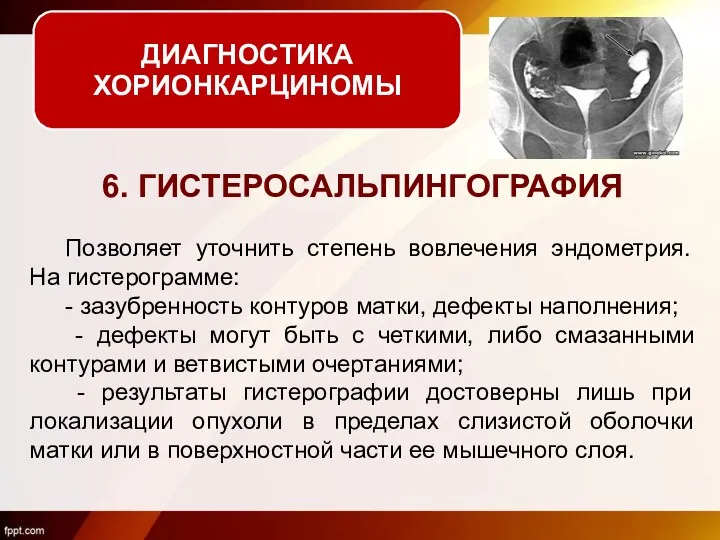 6. ГИСТЕРОСАЛЬПИНГОГРАФИЯ Позволяет уточнить степень вовлечения эндометрия. На гистерограмме: -