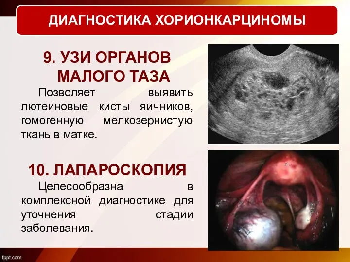 9. УЗИ ОРГАНОВ МАЛОГО ТАЗА Позволяет выявить лютеиновые кисты яичников,