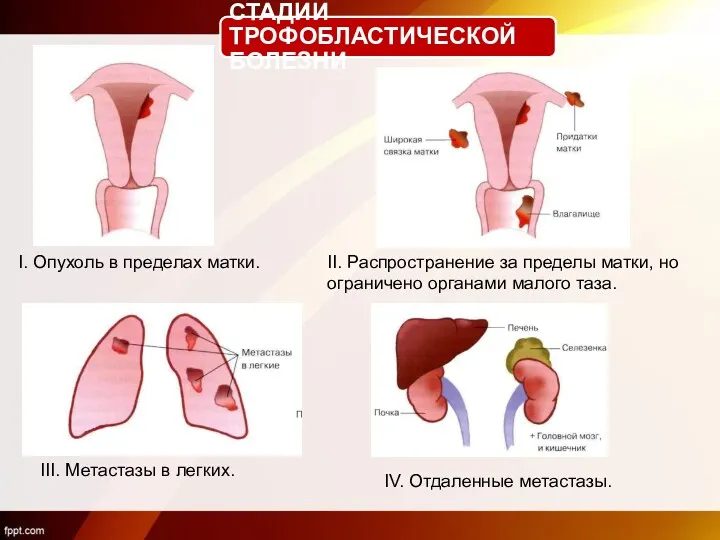 СТАДИИ ТРОФОБЛАСТИЧЕСКОЙ БОЛЕЗНИ I. Опухоль в пределах матки. II. Распространение