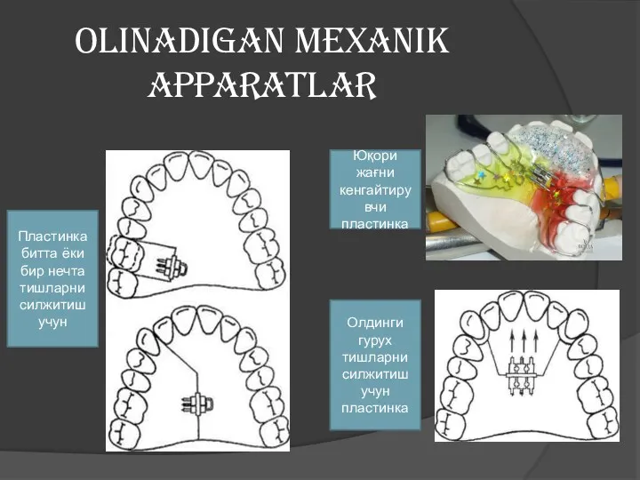 OLINADIGAN MEXANIK APPARATLAR Пластинка битта ёки бир нечта тишларни силжитиш учун Олдинги гурух