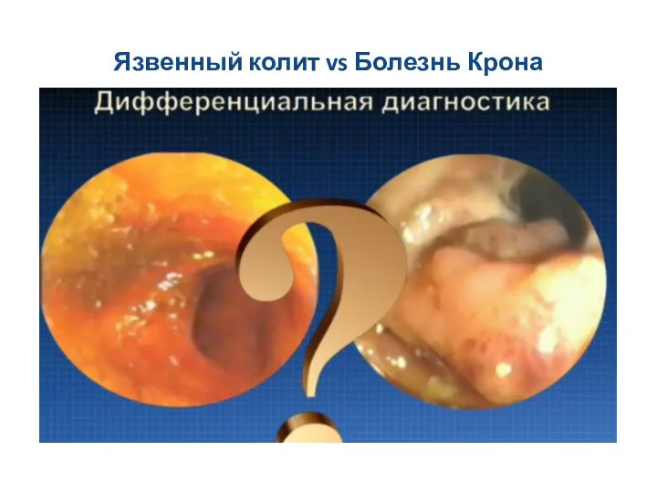 Язвенный колит vs Болезнь Крона