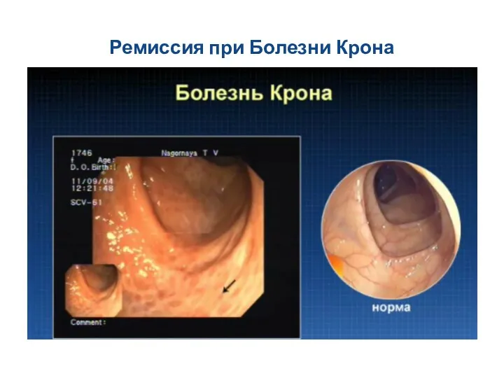 Ремиссия при Болезни Крона