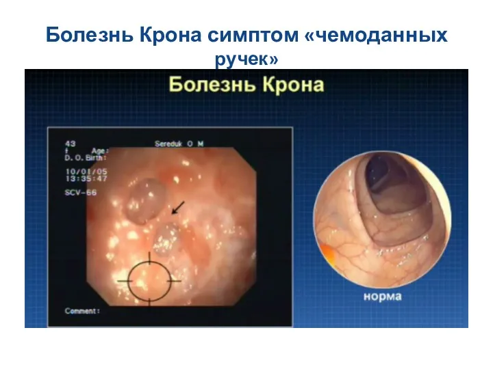 Болезнь Крона симптом «чемоданных ручек»