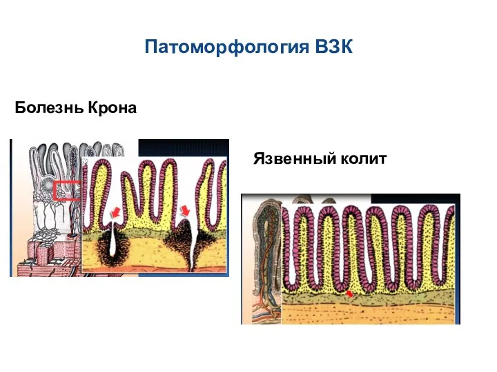 Патоморфология ВЗК Язвенный колит Болезнь Крона