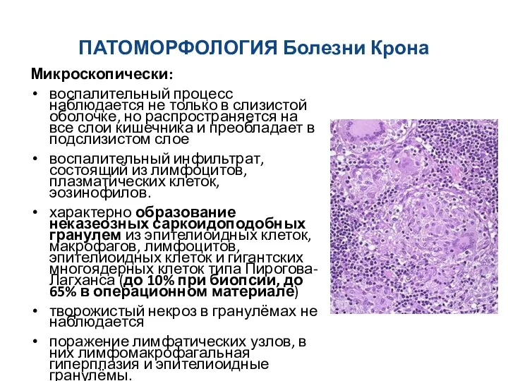 ПАТОМОРФОЛОГИЯ Болезни Крона Микроскопически: воспалительный процесс наблюдается не только в