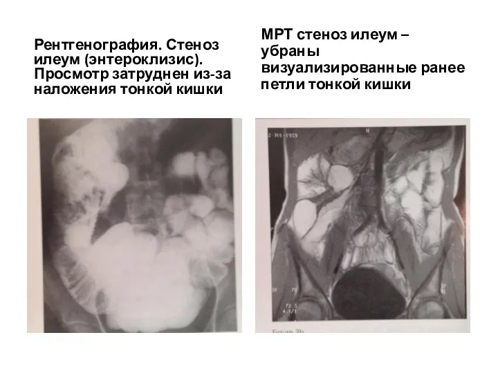 Рентгенография. Стеноз илеум (энтероклизис). Просмотр затруднен из-за наложения тонкой кишки