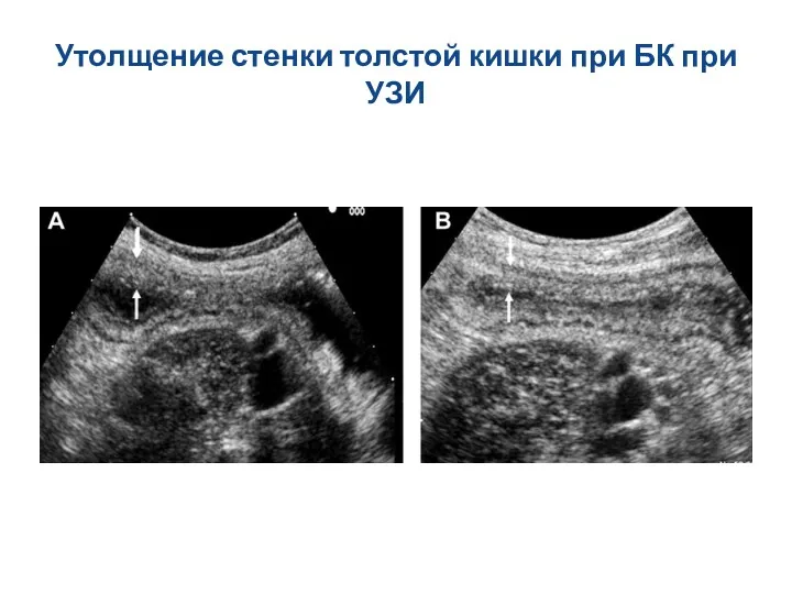 Утолщение стенки толстой кишки при БК при УЗИ