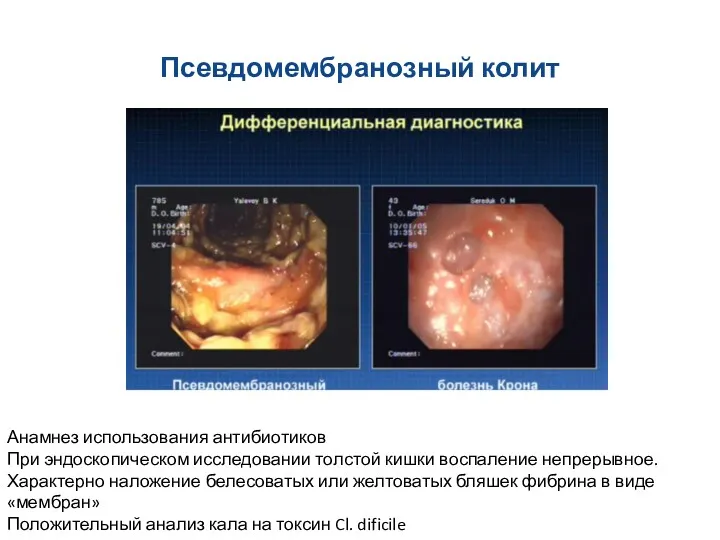 Псевдомембранозный колит Анамнез использования антибиотиков При эндоскопическом исследовании толстой кишки